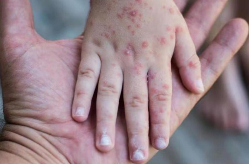 Brote de sarampión en México: 4,849 casos confirmados y 22 muertes