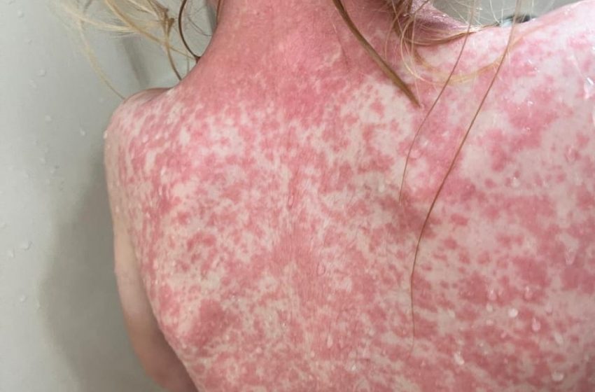  Epidemia de sarampión aumenta en EU con 600 casos en Carolina del Sur