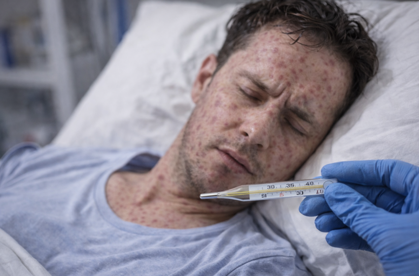  Muertes por sarampión en México: aumento a 29 fallecidos con primer deceso en Chiapas en 2025