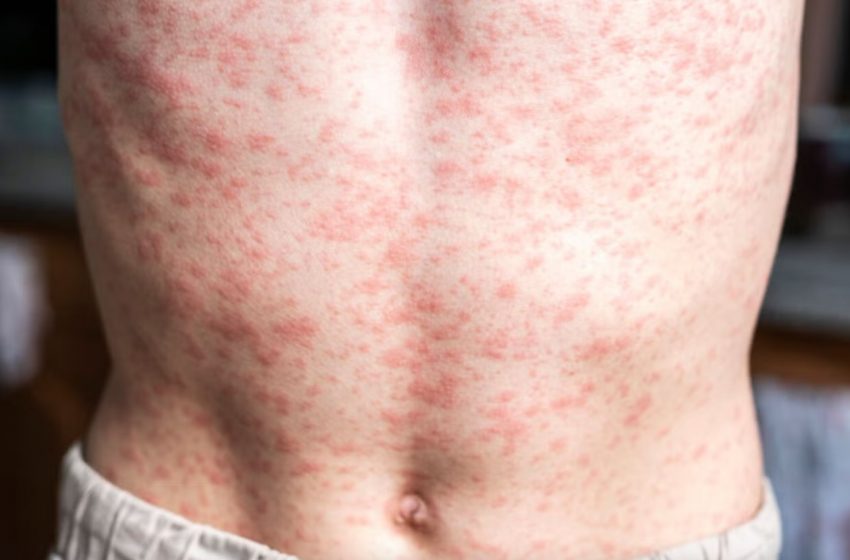  Brote de sarampión en México: 28 muertes y primer deceso en la Ciudad de México